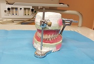 Lower Jaw Overdenture Treatment
