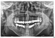 Dental Crowns and Bridges in Dubai
