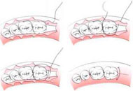 Flap Surgery in Dubai