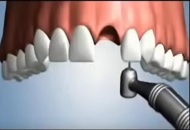 How to Treat a Broken Tooth
