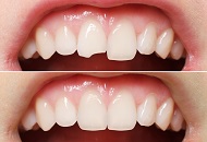 How to Correct Chipped Teeth