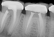 Treatments for Root Fractures
