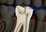 Treatment for Cracked Tooth Syndrome