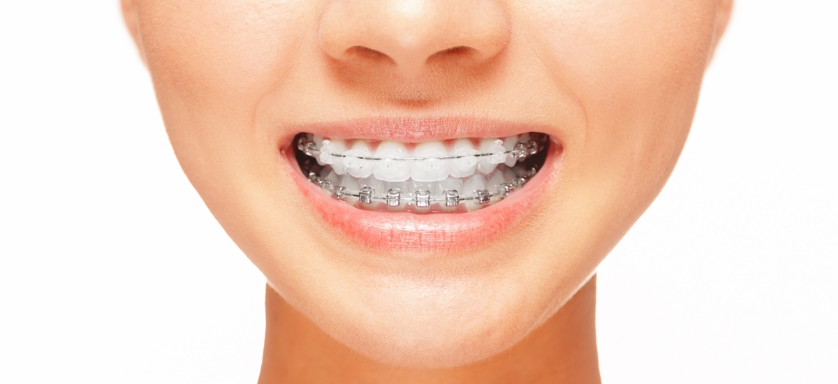 How to Apply Braces in Dubai