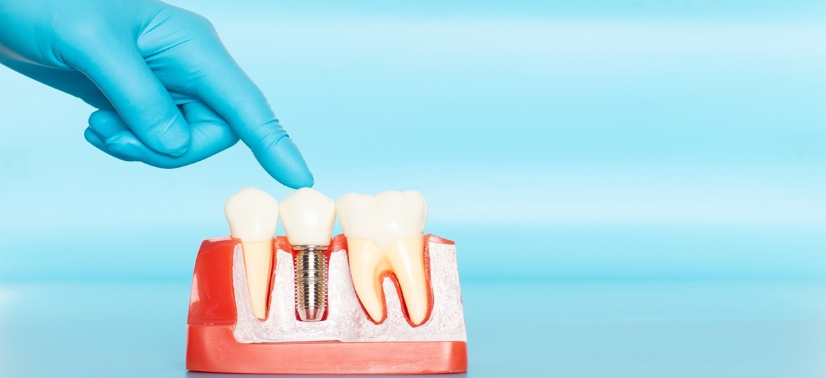 Rapid Dental Implants in Dubai